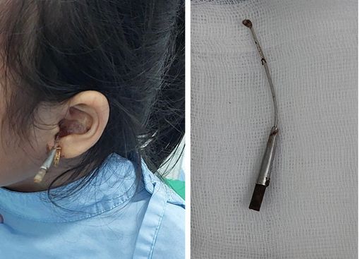 Cần Thơ: Bé gái bị thủng màng nhĩ do tự lấy ráy tai